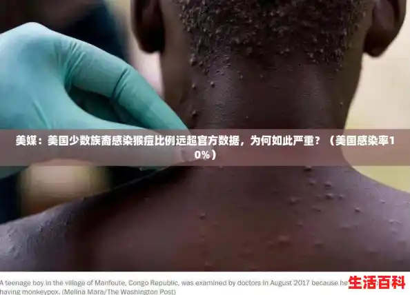 美媒：美国少数族裔感染猴痘比例远超官方数据，为何如此严重？（美国感染率10%）